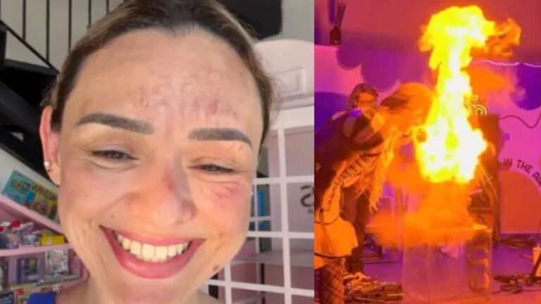Arlen Hernández, la influencer de Tampa Bay, sufre quemaduras en el rostro por un ‘pastel explosivo’